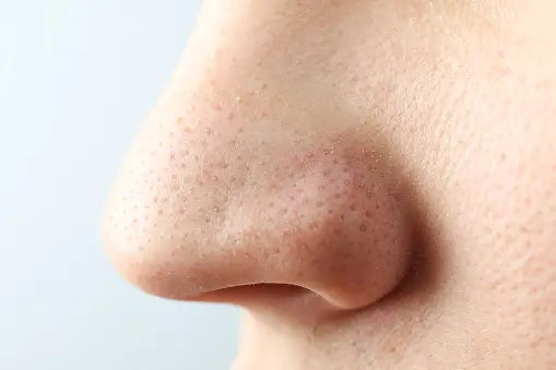 Understanding Blackheads: Causes, Treatments, and Prevention Tips